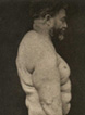 Plate 13 Lipomatosis perimuscularis circumscripta