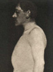 Plate 16 Acromegaly