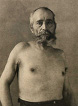 Plate 33 Myositis interstitialis chronica