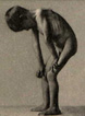 Plate 8-9 Dystrophia muscularis progressiva infantilis